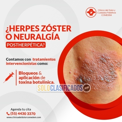 HERPES ZÓSTER O NEURALGÍA POSTHERPETICA... 